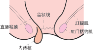 痔核脱出图示 痔核脱出图示