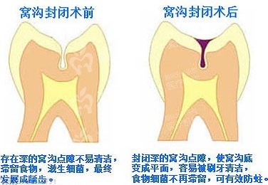 牙齿窝沟封闭前后对比示意图 牙齿窝沟封闭前后对比示意图