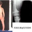抗维生素D佝偻病 抗维生素D佝偻病