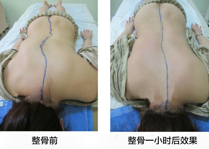 整脊疗法 整脊疗法