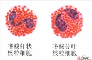 特发性嗜酸性粒细胞增多综合症 特发性嗜酸性粒细胞增多综合症