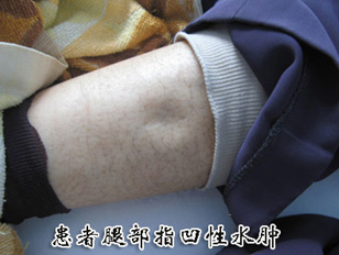 肾性浮肿 肾性浮肿