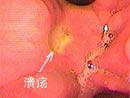 溃疡 溃疡