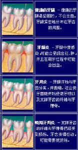 牙龈病 牙龈病