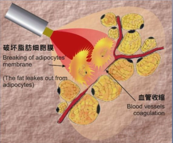 溶脂过程图解 溶脂过程图解