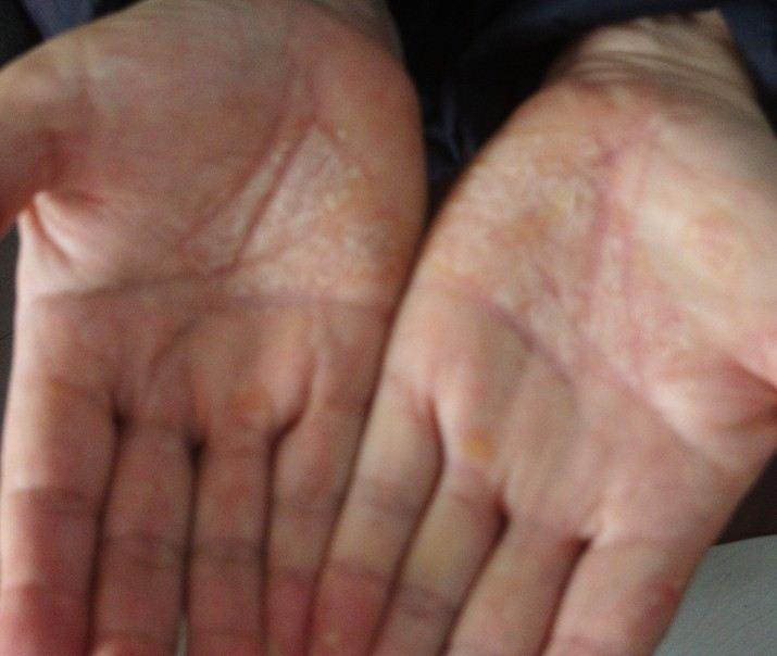 湿疹治疗 湿疹治疗