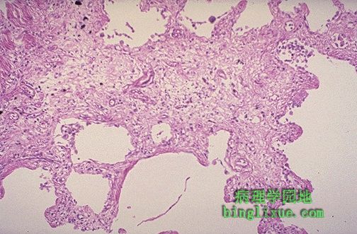 特发性瀰漫性肺纤维化 特发性瀰漫性肺纤维化