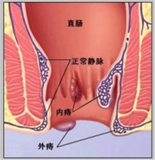 炎性外痔疮 炎性外痔疮