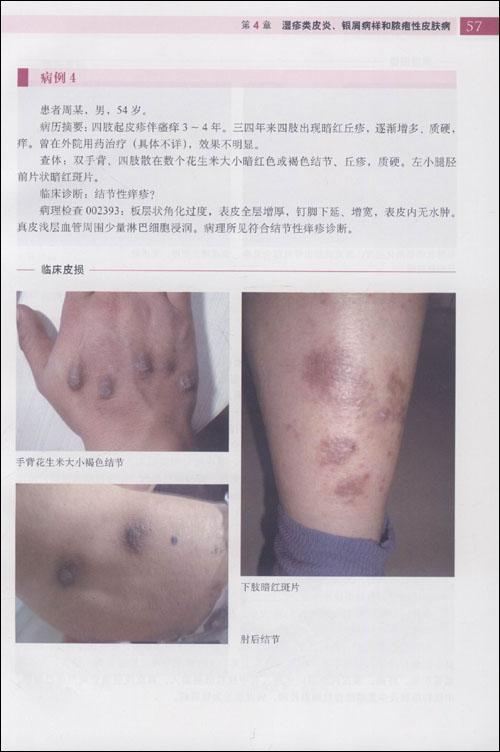 营养与代谢障碍性皮肤病 营养与代谢障碍性皮肤病
