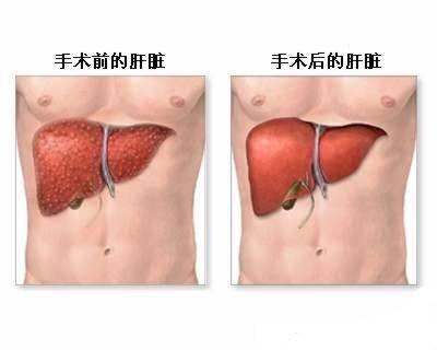 活体肝移植 活体肝移植